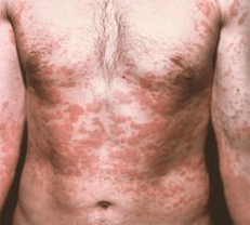 La piel problemática es un síntoma de la presencia de parásitos.