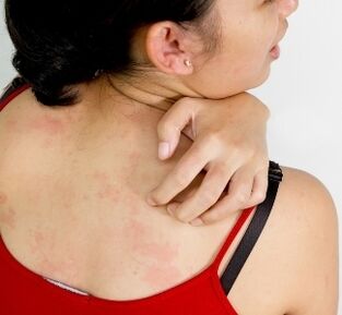 granulomas en el cuerpo síntomas de la presencia de parásitos