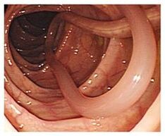 parásitos en el cuerpo humano