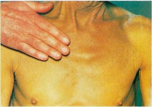 Ictericia debido a parásitos en el cuerpo.
