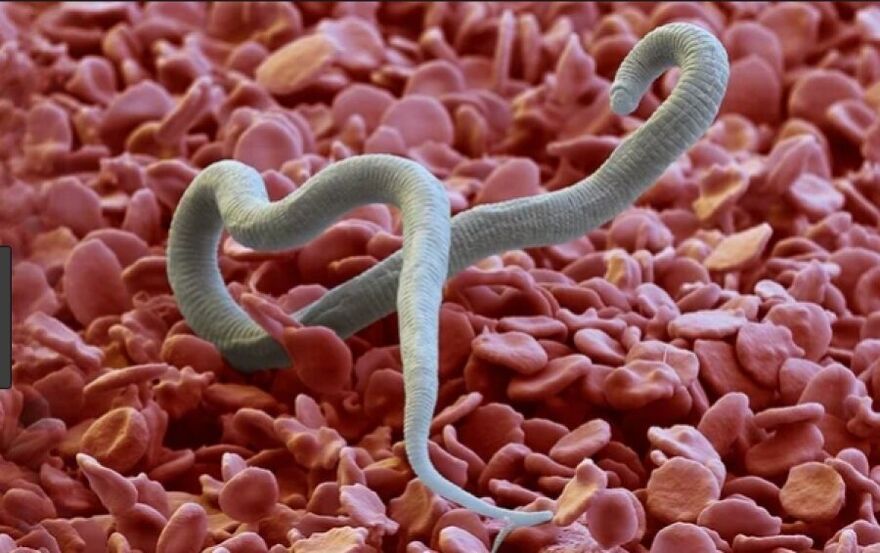 gusanos en el cuerpo humano