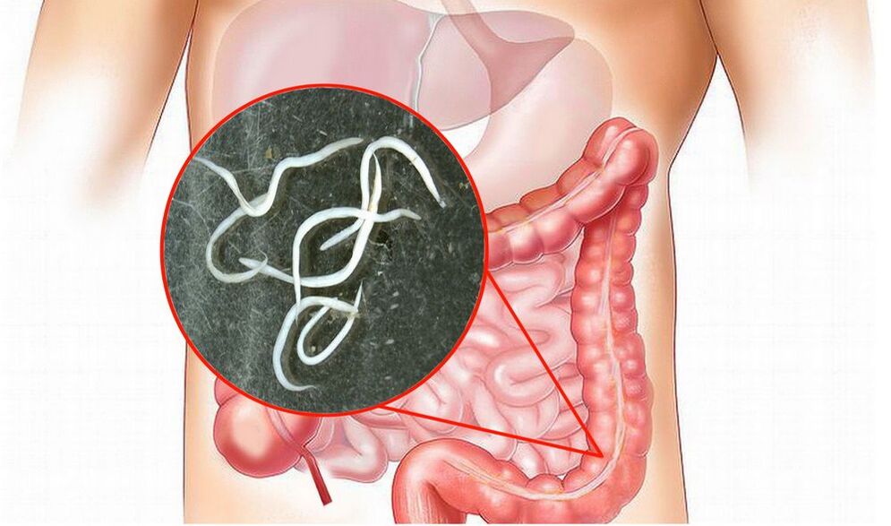 gusanos en el intestino